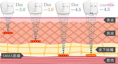 施術部位ごとに超音波があたる深さを調節
