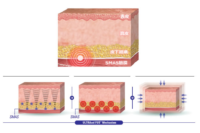 HIFUのメカニズム